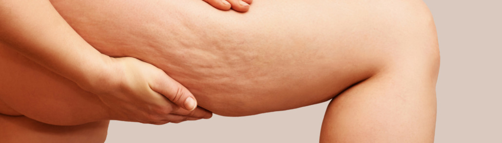 Quel est mon type de cellulite ? 8