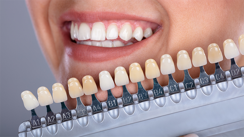 Comment rendre mes dents blanches ? 2