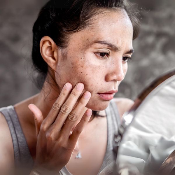 Comment atténuer les taches pigmentaires de la peau ?