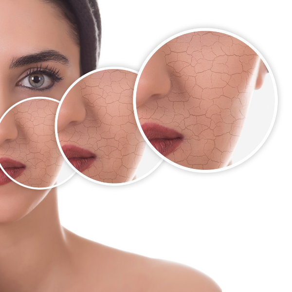Comment prendre soin d'une peau sèche ? - Le blog Easypara