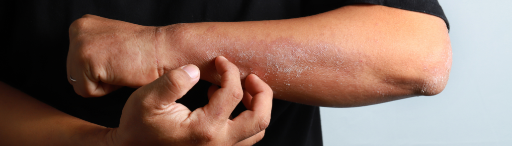 Top 5 des remèdes pour soigner l'eczéma 6