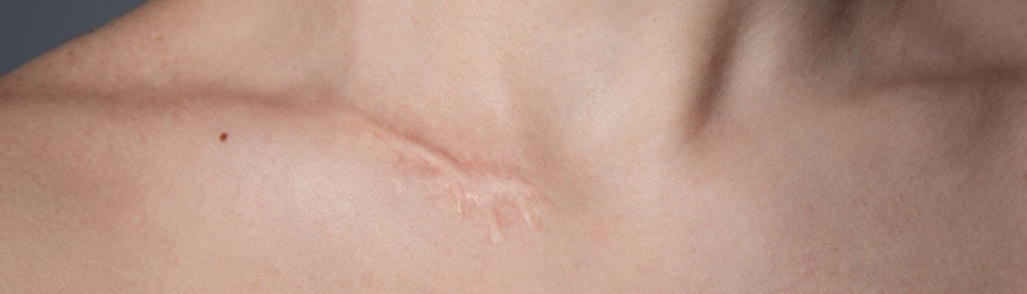 Comment aider la peau à cicatriser plus vite ? 1