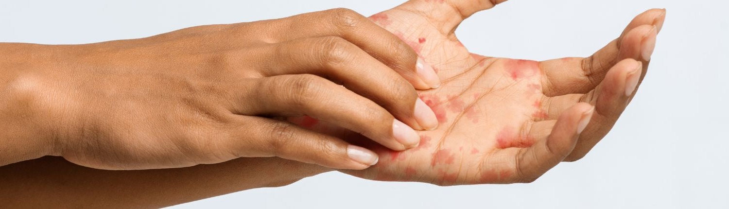 Eczéma des mains : quels sont les symptômes, causes et traitements ? 10