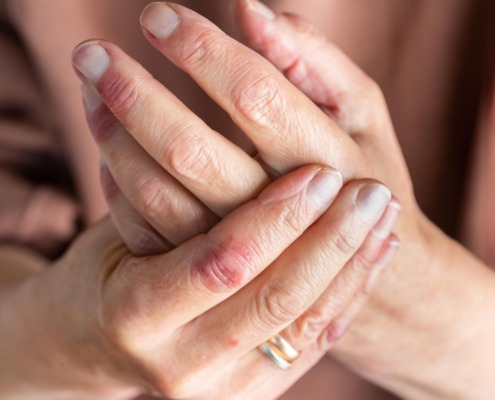 Eczéma des mains : quels sont les symptômes, causes et traitements ? 12