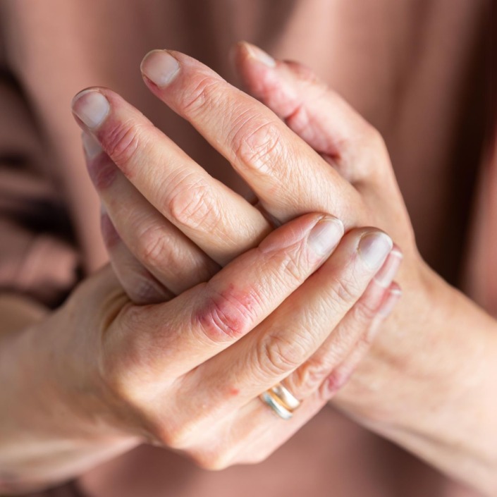 Eczéma des mains : quels sont les symptômes, causes et traitements ? 12