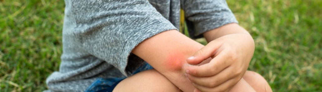 Top 5 des meilleurs soins apaisants contre les piqûres de moustiques 4