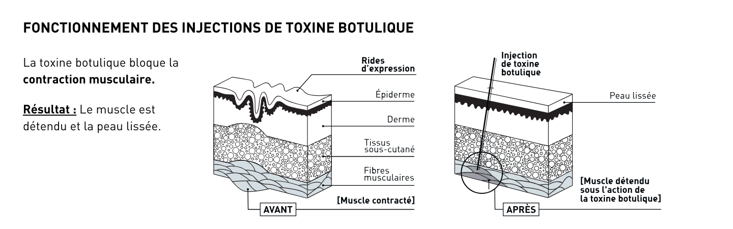 Les rides d’expression : quelles solutions pour les atténuer ? 14