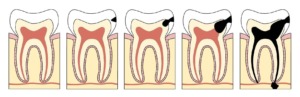 Optimisez votre routine bucco-dentaire pour une bouche sans caries 2