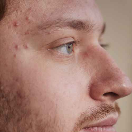 Acne1